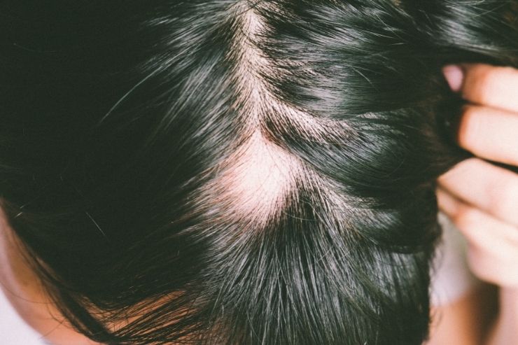 Alopecia (Hair Loss)