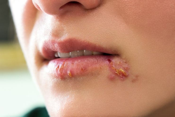 Cold Sores (Herpes Simplex)