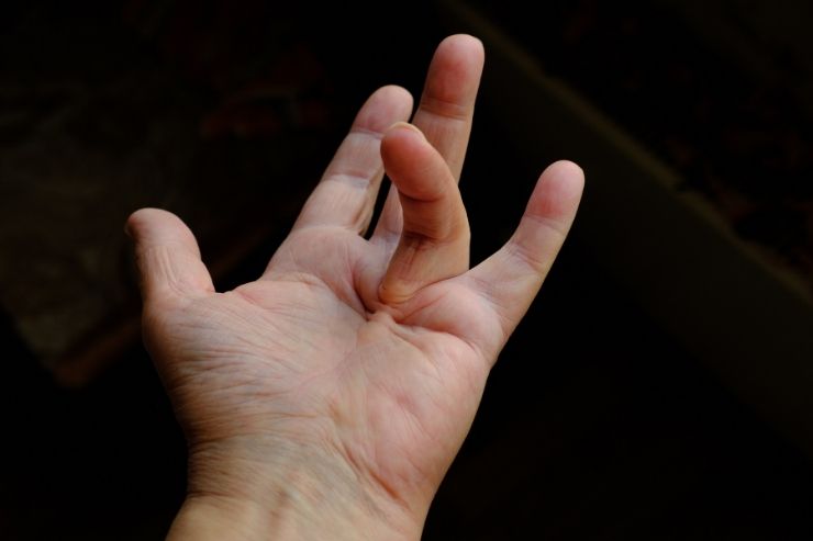 Dupuytren's Contracture