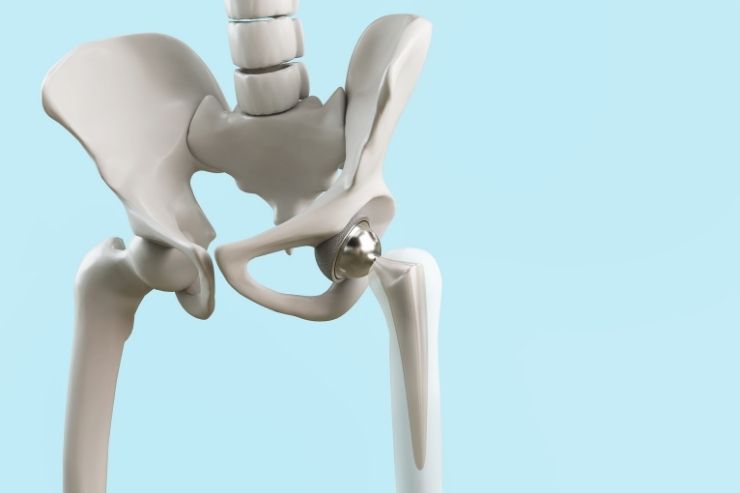 Hip Replacement