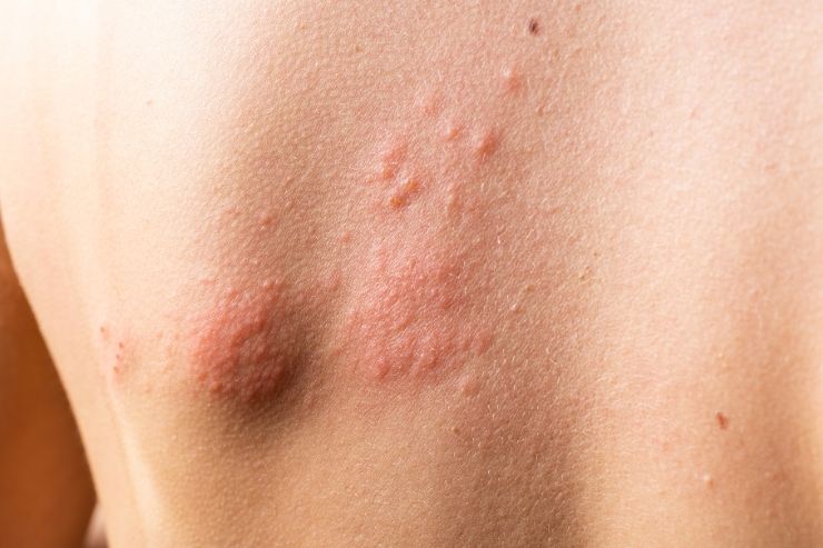 Hives (Urticaria)