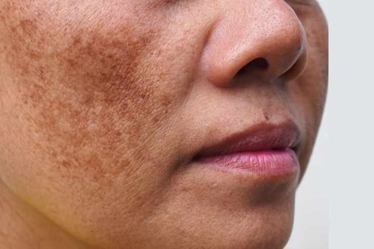 Melasma