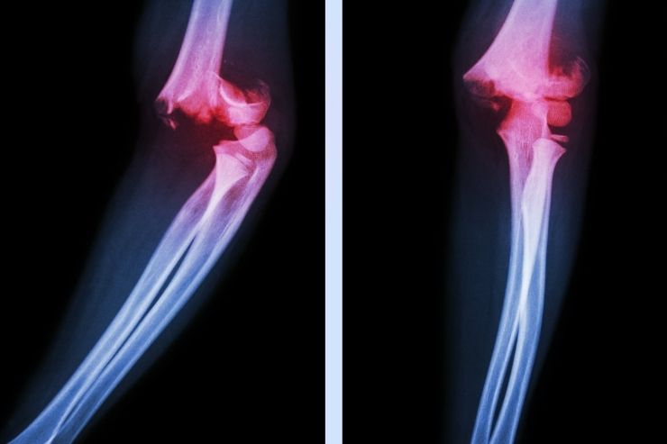 Osteoporotic Fractures