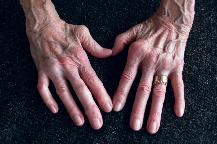 Rheumatoid Arthritis