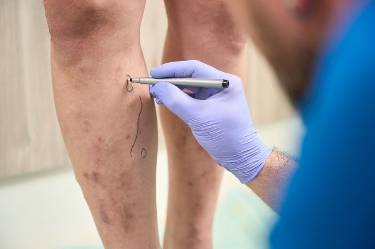 Varicose and Spider Vein Treatment